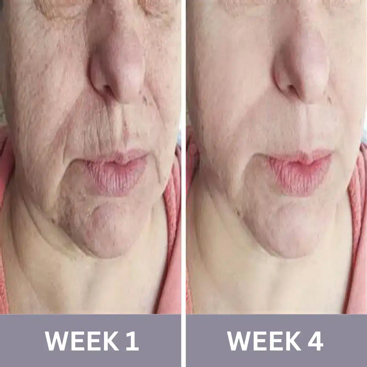 Radiance One Handset Before and After Results