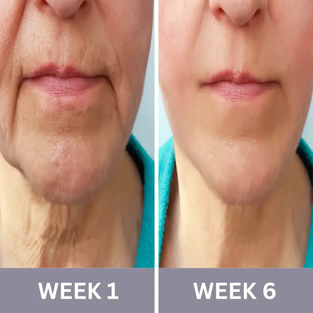 Radiance One Handset Before and After Results